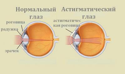 Нормальный глаз и глаз с астигматизмом